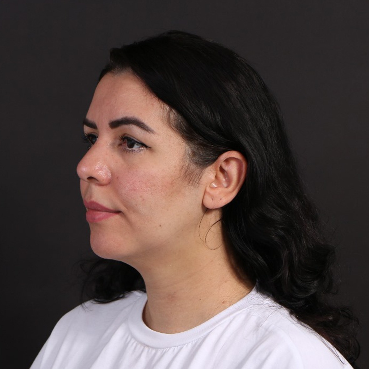 After chin augmentation surgery at Cocoona Clinic Dubai showing improved chin projection and enhanced facial profile.