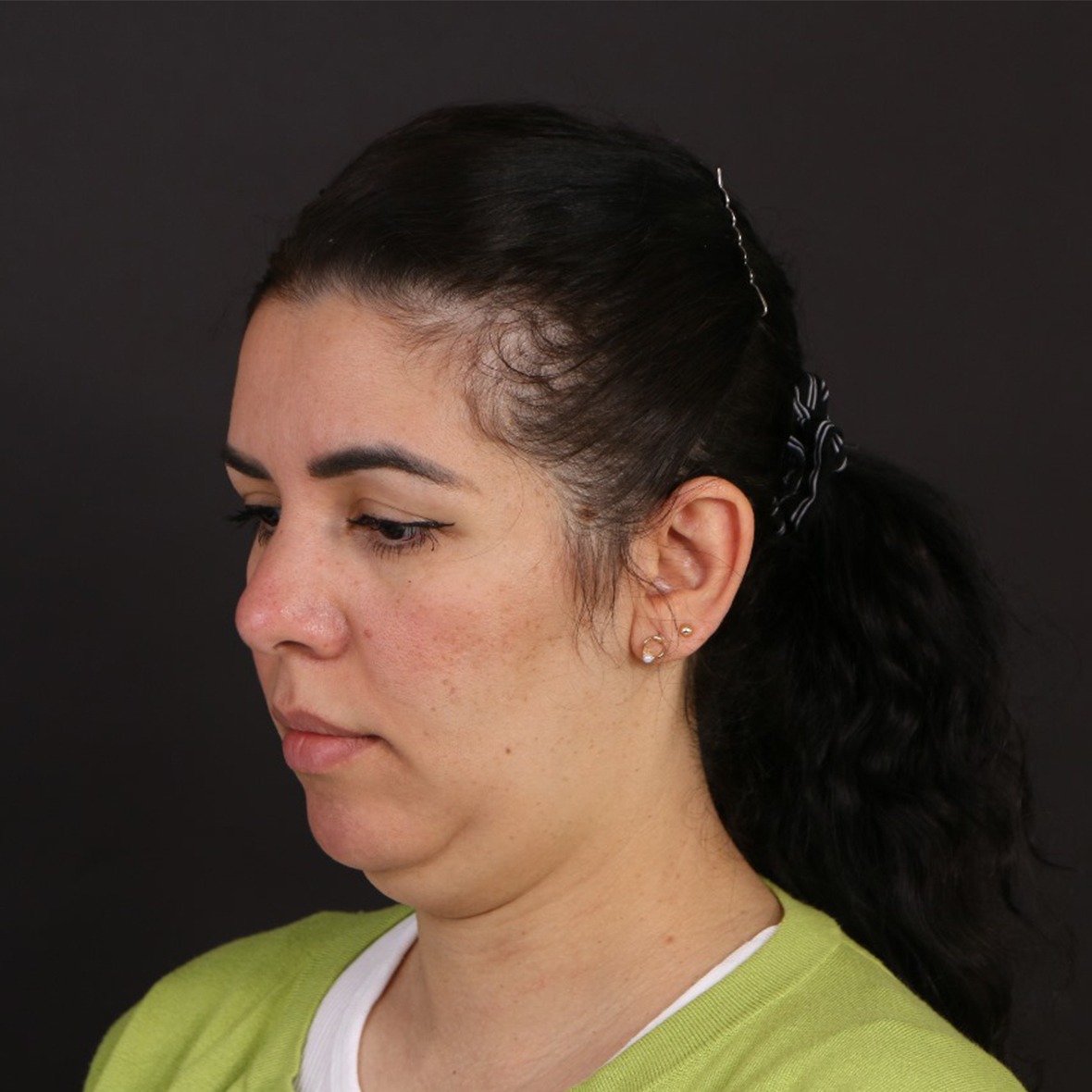 Before chin augmentation surgery at Cocoona Clinic Dubai showing the patient's chin profile before enhancement.