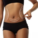 A detailed close-up frontal view of a woman's torso against a white background, wearing black compression shorts and a sports top, with white surgical diagram lines and direction arrows overlaying her waist and abdomen while a hand pinches loose flank tissue to outline a clinical treatment plan for VASER Liposuction Dubai.