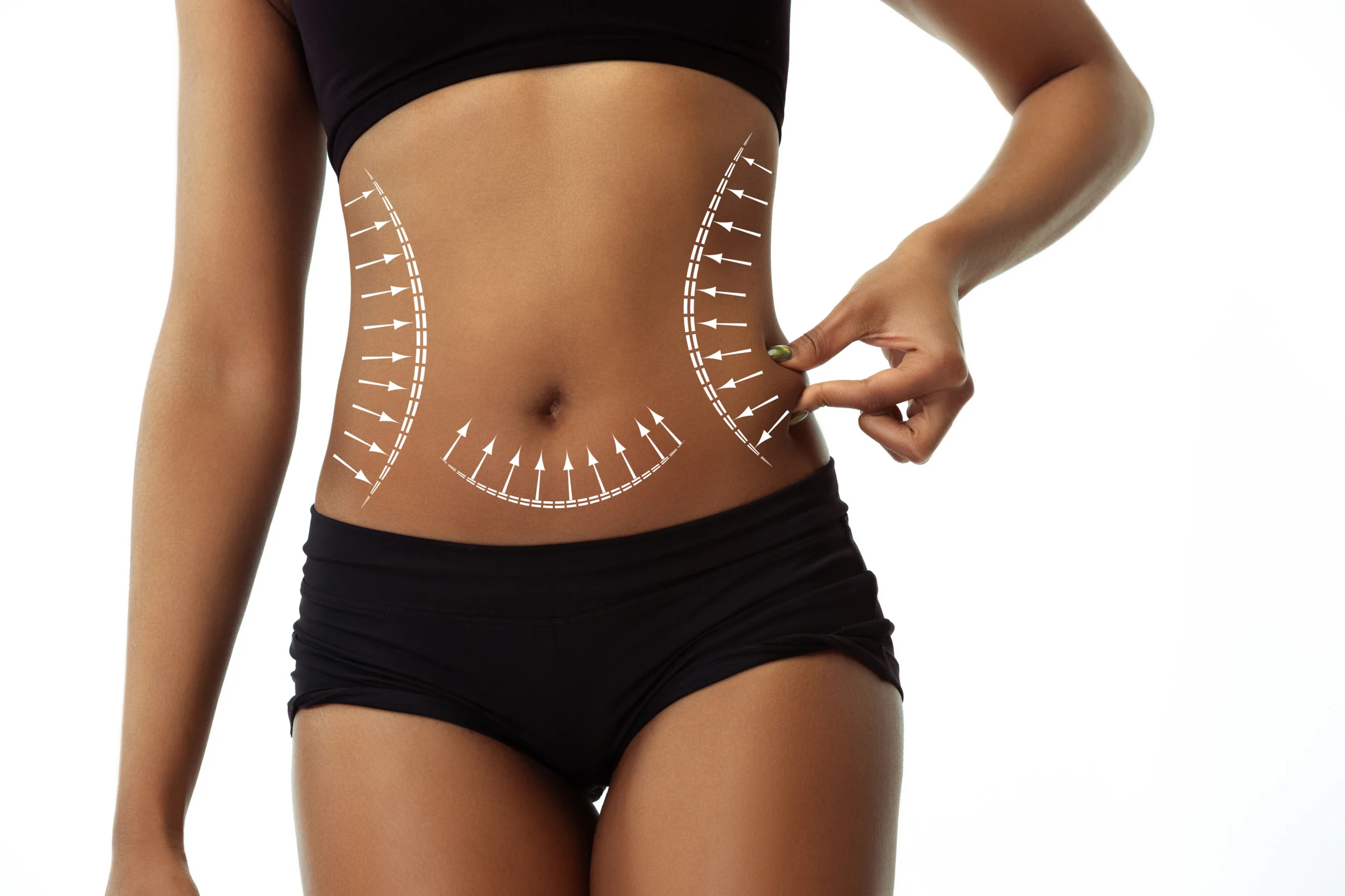 A detailed close-up frontal view of a woman's torso against a white background, wearing black compression shorts and a sports top, with white surgical diagram lines and direction arrows overlaying her waist and abdomen while a hand pinches loose flank tissue to outline a clinical treatment plan for VASER Liposuction Dubai.