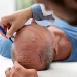 A surgeon using a blue marker to outline the new frontal hairline and graft recipient zones on a male patient’s scalp, acting as the starting baseline for a hair transplant before and after progression.