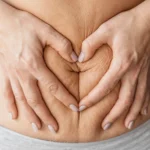 A close-up view of a woman framing her loose, wrinkled abdominal skin with her hands in a heart shape, illustrating the common post-pregnancy tissue laxity addressed during a mommy makeover dubai.