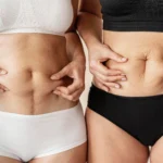 A close-up frontal view of two women standing side-by-side in underwear, both pinching the skin and tissue around their midsections to demonstrate tissue elasticity and determine candidacy for abdominal liposuction vs tummy tuck Dubai.