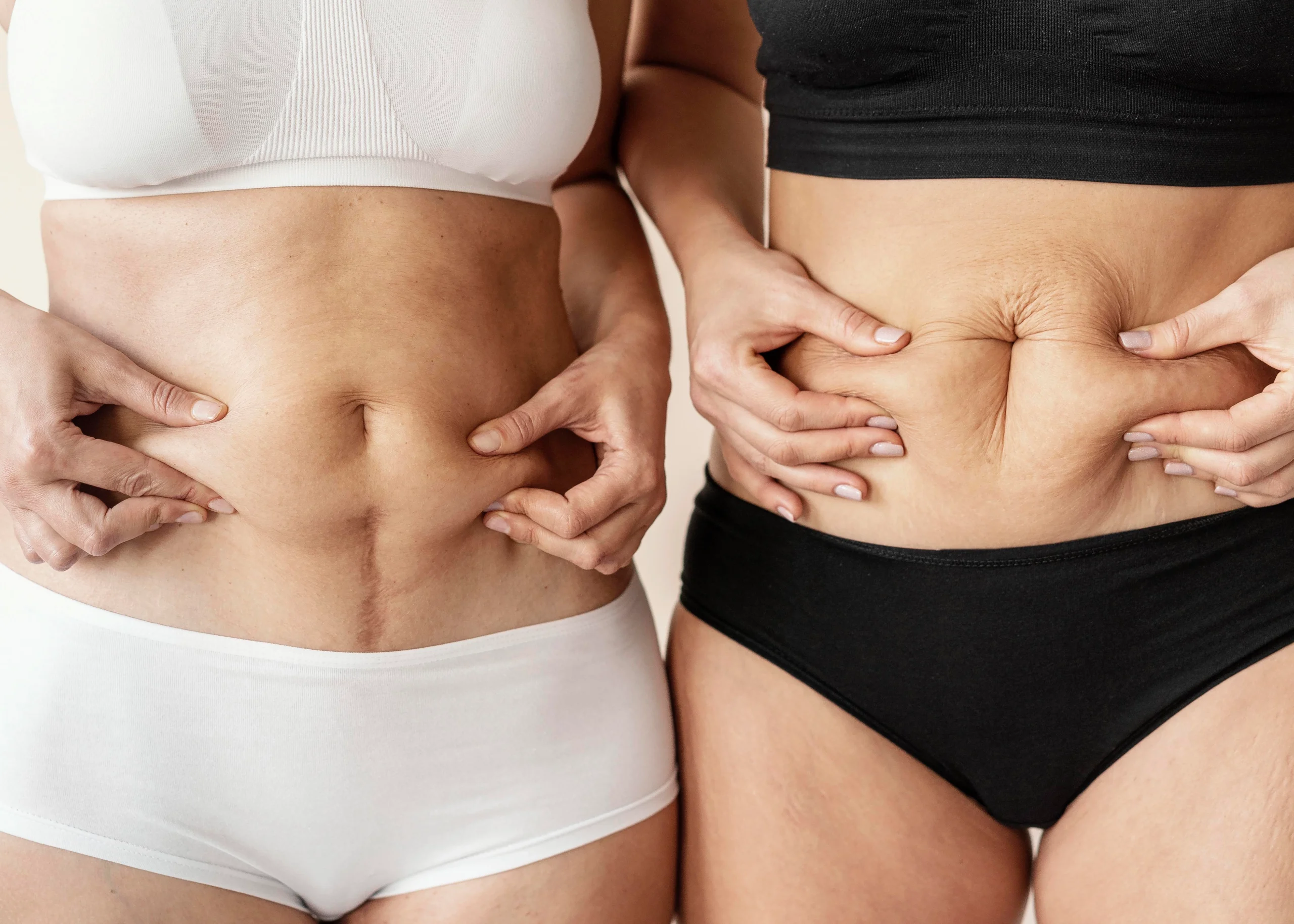 A close-up frontal view of two women standing side-by-side in underwear, both pinching the skin and tissue around their midsections to demonstrate tissue elasticity and determine candidacy for abdominal liposuction vs tummy tuck Dubai.