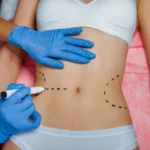 An overhead, close-up view of a patient lying down in white underwear on a pink sterile sheet, while a practitioner wearing blue nitrile gloves uses a white marker to sketch symmetrical dashed lines across her waistline to highlight selection standards for the Best Liposuction Surgeon Dubai.