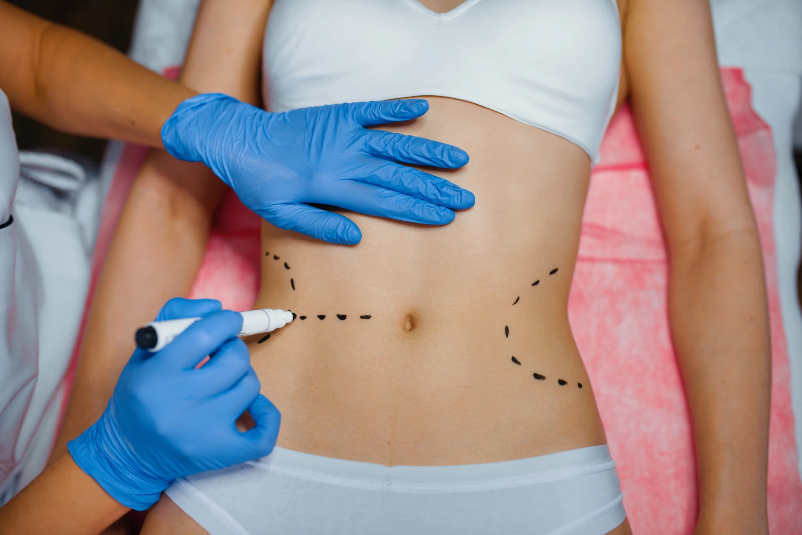 An overhead, close-up view of a patient lying down in white underwear on a pink sterile sheet, while a practitioner wearing blue nitrile gloves uses a white marker to sketch symmetrical dashed lines across her waistline to highlight selection standards for the Best Liposuction Surgeon Dubai.