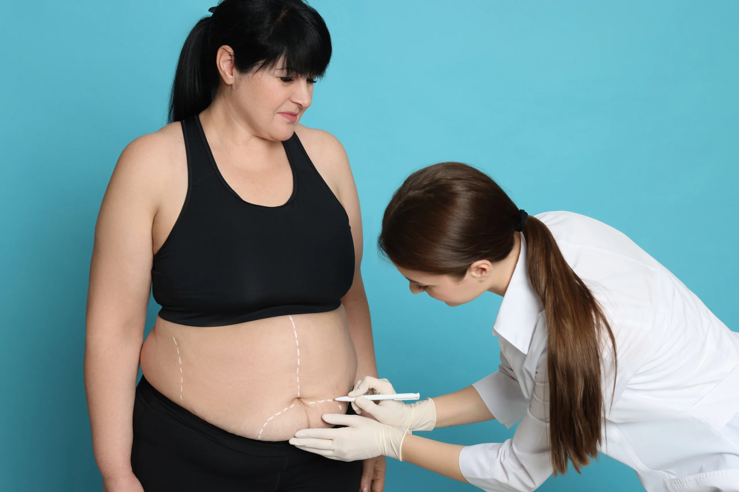 A three-quarters clinical view of a patient standing against a cyan background while a female surgeon in a white medical coat and sterile gloves uses a marker to draw precise preoperative incision lines across the lower abdomen to plan a Mommy Makeover Surgery Dubai.