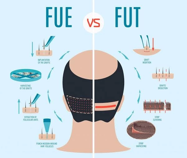 A detailed clinical infographic titled FUE vs FUT comparing hair transplant methods, showing a posterior view of a scalp split down the center to illustrate individual punch extraction versus linear strip harvesting for FUT vs FUE Graft Yield in Dubai.