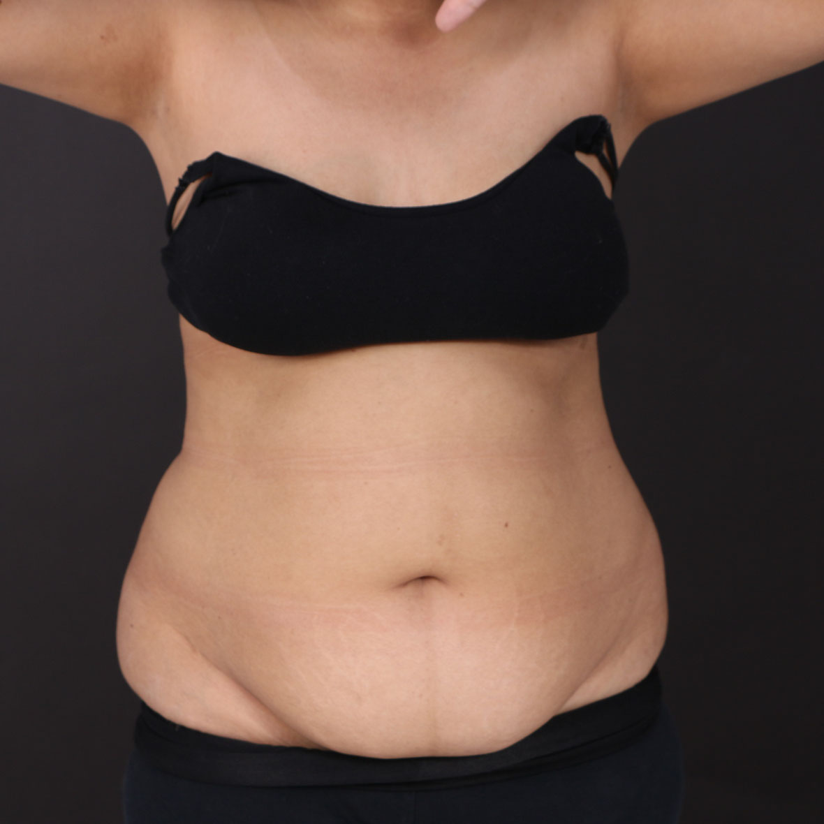 Before full body liposuction results at Cocoona Dubai