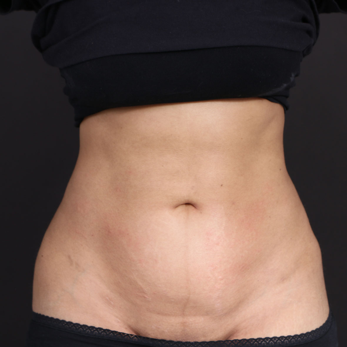 After full body liposuction results at Cocoona Dubai
