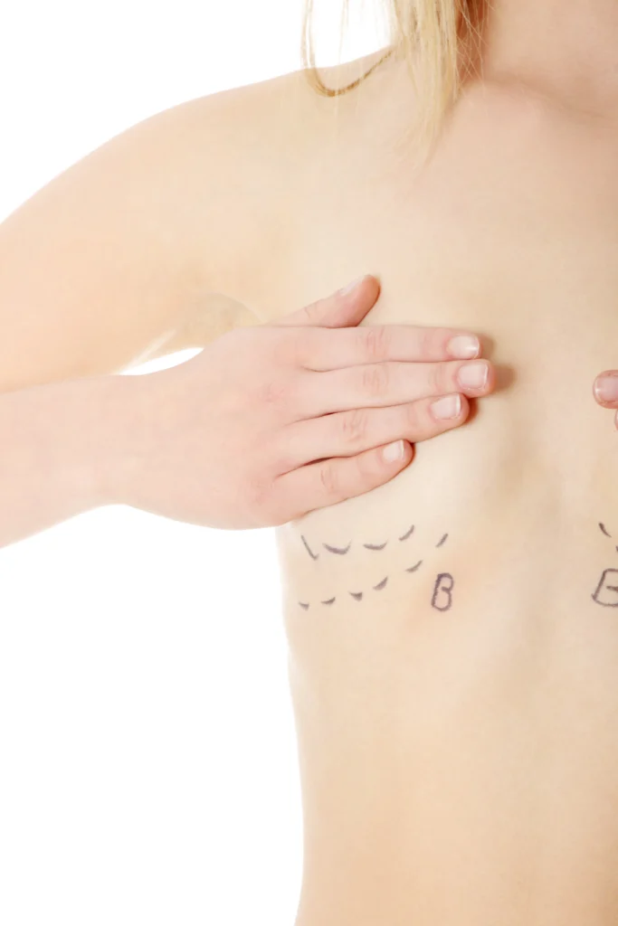 A close-up three-quarters perspective of a shirtless woman's torso against a plain white background, with her right hand positioned over her chest while black marker guidelines and the letter B are drawn on the skin below the breast to illustrate surgical planning for a Breast Augmentation in Dubai.