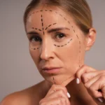 A detailed close-up frontal view of a woman's face against a neutral gray background, featuring black surgical planning marker lines drawn across her forehead, under her eyes, and along her jawline, while her hands pinch loose skin at her chin and jaw to demonstrate a baseline for a Deep Plane Facelift Dubai.