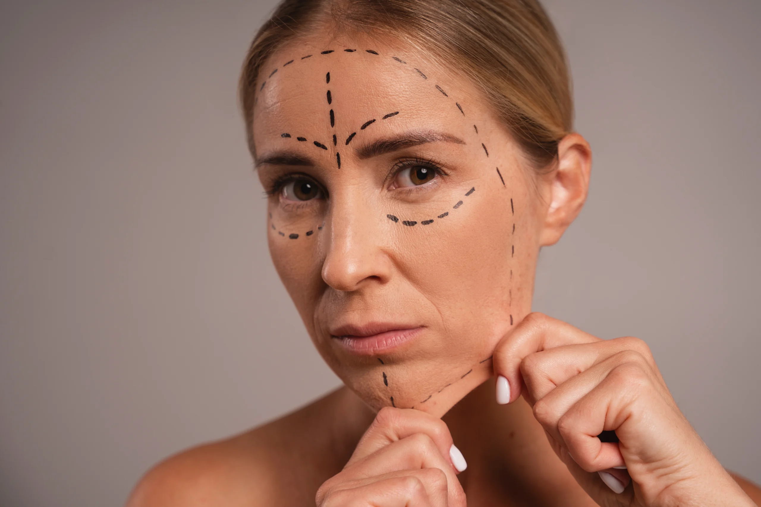 A detailed close-up frontal view of a woman's face against a neutral gray background, featuring black surgical planning marker lines drawn across her forehead, under her eyes, and along her jawline, while her hands pinch loose skin at her chin and jaw to demonstrate a baseline for a Deep Plane Facelift Dubai.