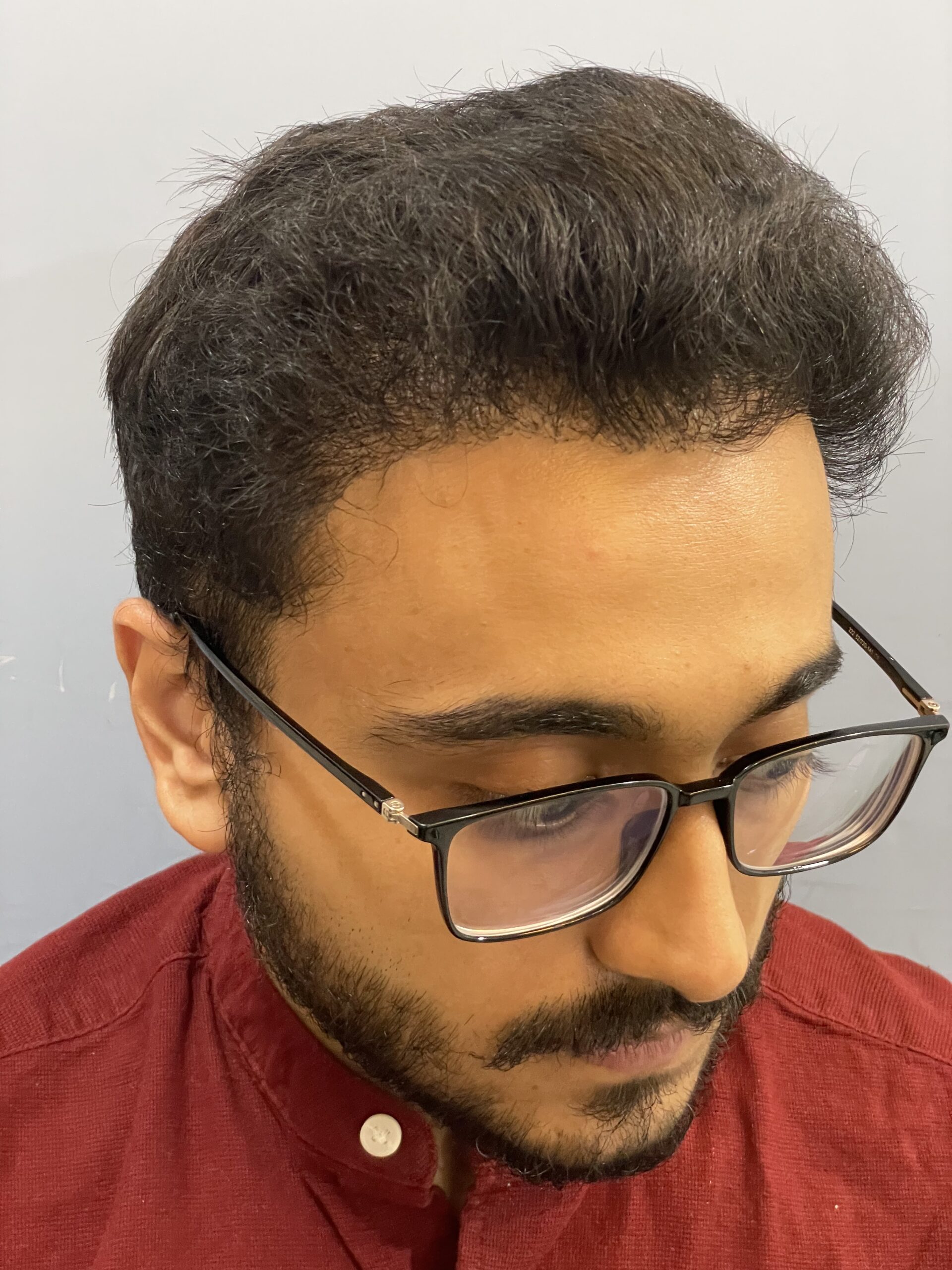 FUE Hair Transplant in Dubai at cocoona