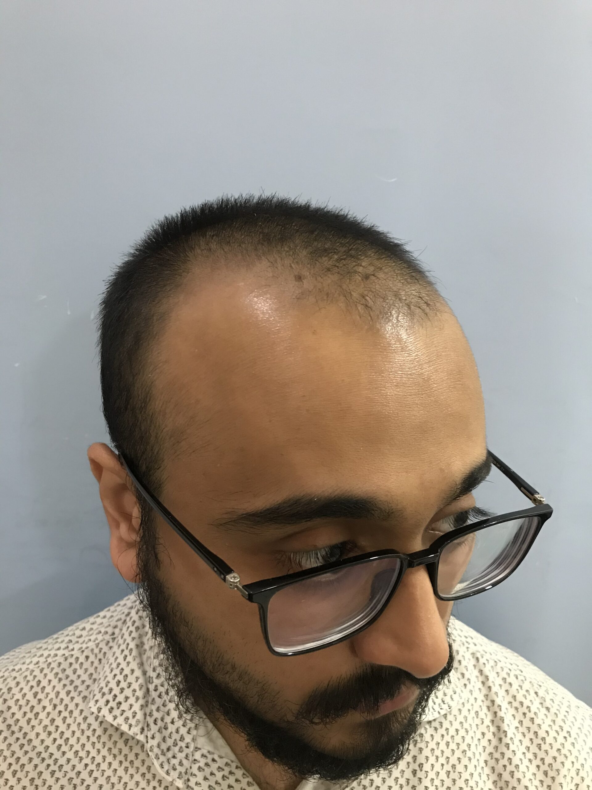 before FUE Hair Transplant in Dubai at cocoona