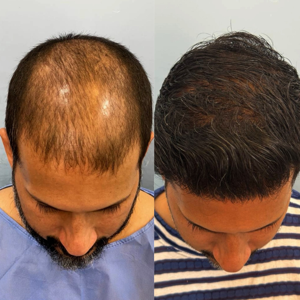 hair-transplant-in-dubai