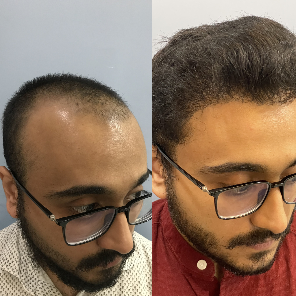 fue-hair-transplant-in-dubai