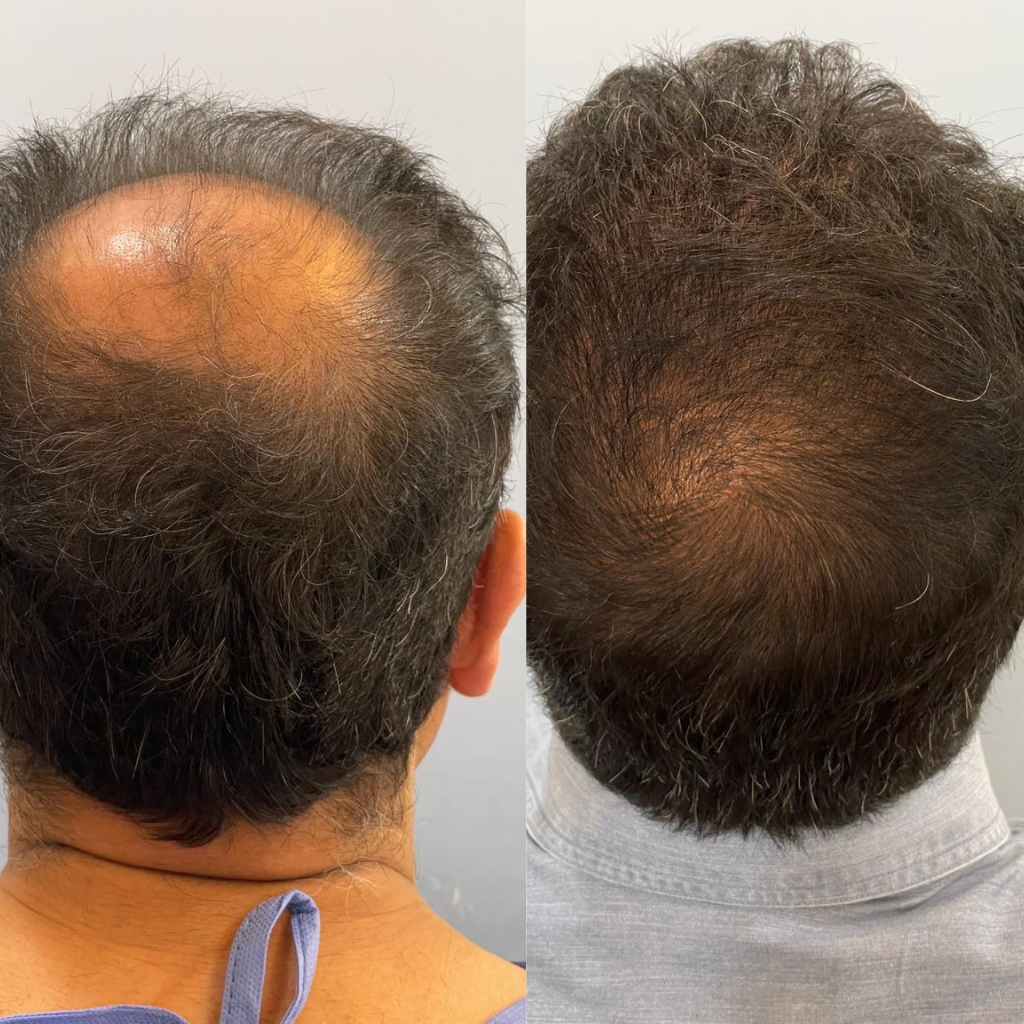 hair-transplant-in-dubai
