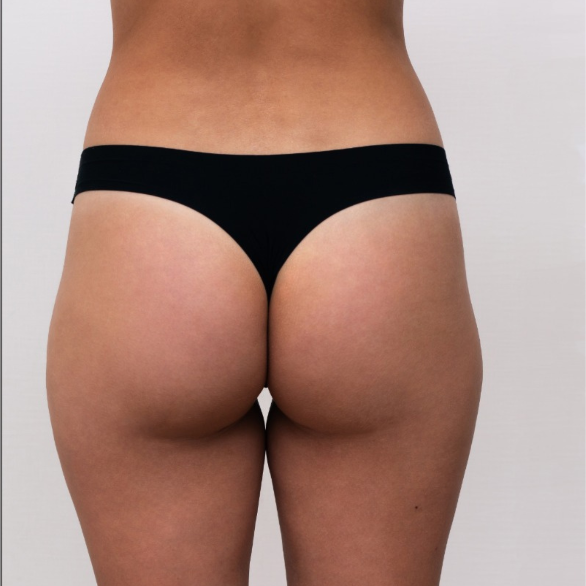before Butt Lift In Dubai at cocoona