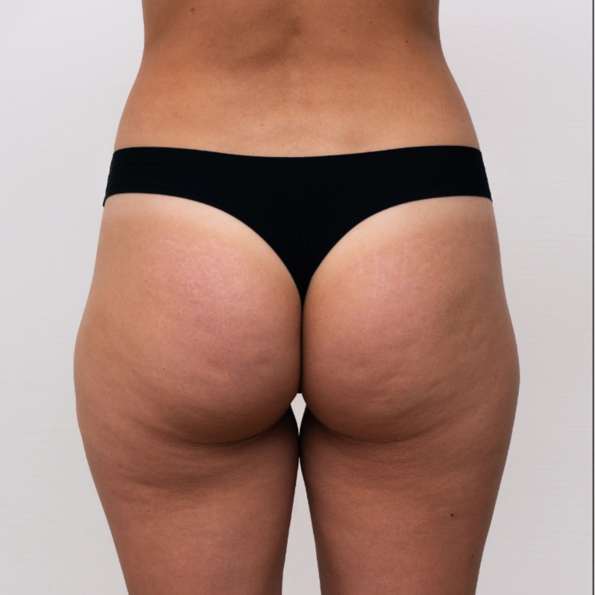 before Butt Lift In Dubai at cocoona
