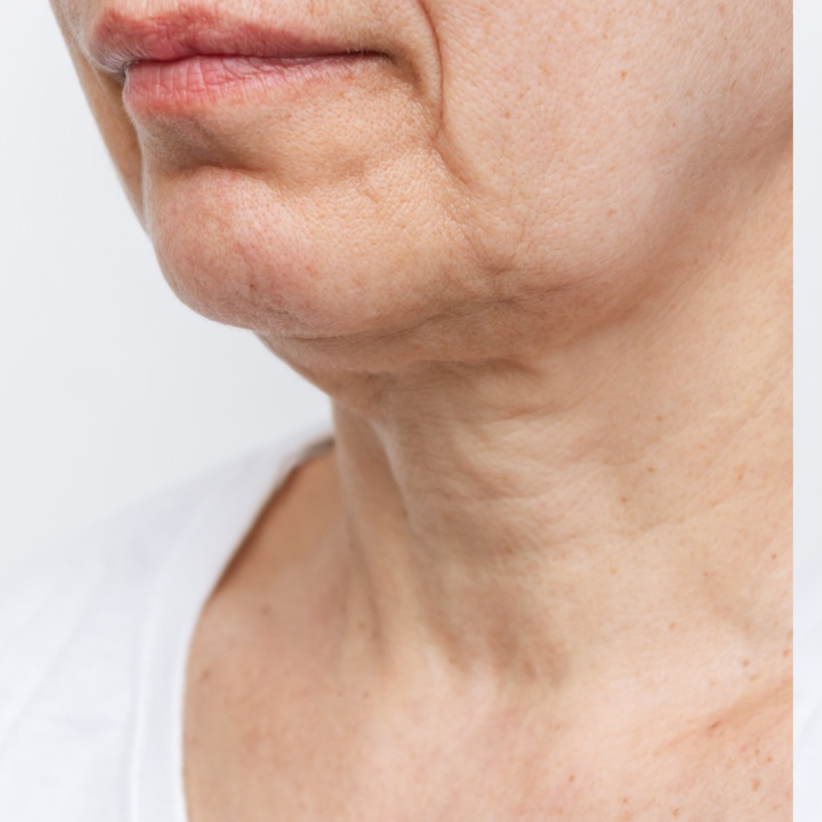 before Neck Lift in Dubai at cocoona