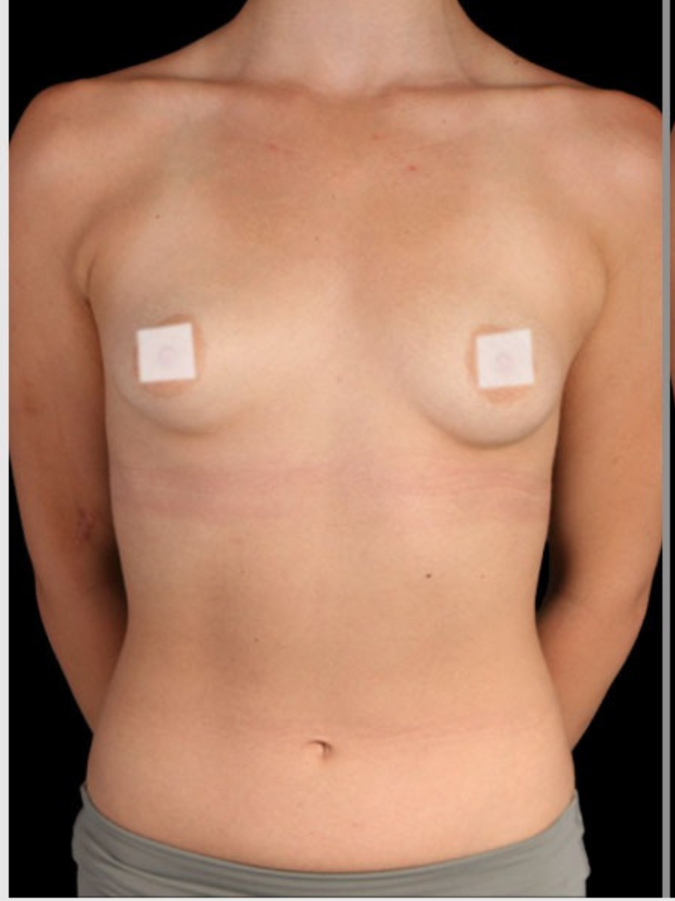 before Breast Augmentation in Dubai at cocoona clinic