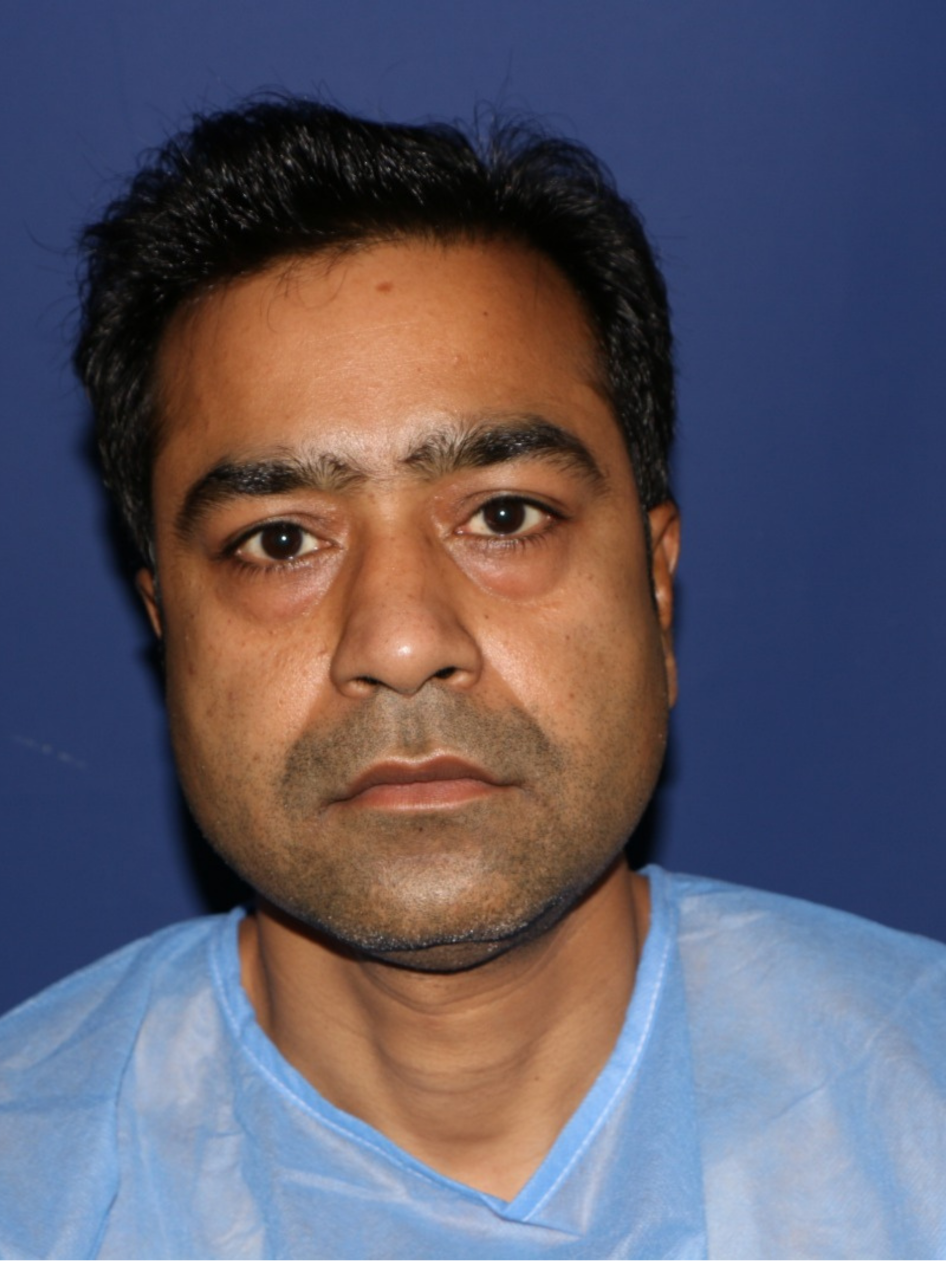 before Blepharoplasty in Dubai at cocoona clinic