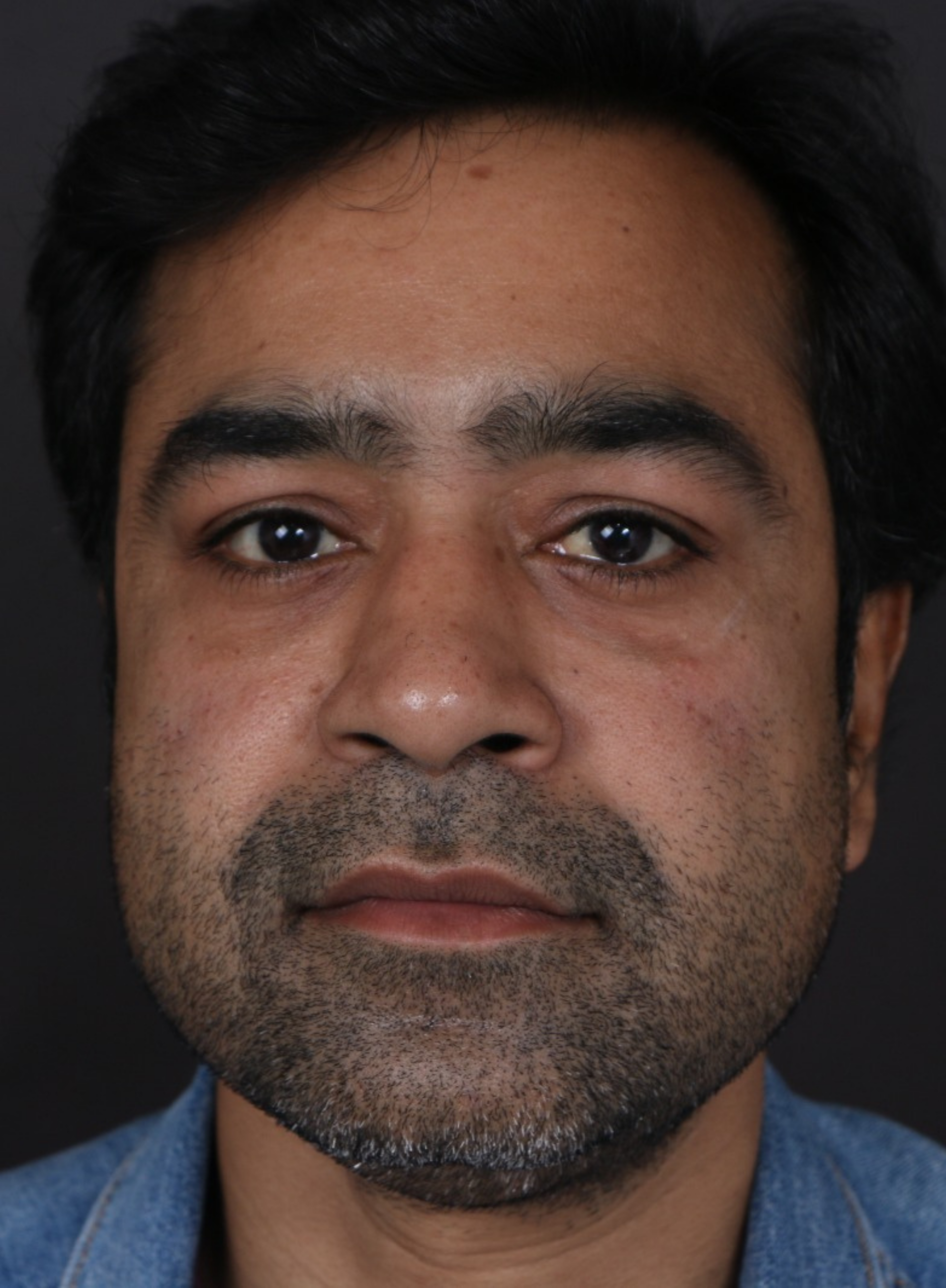 after Blepharoplasty in Dubai at cocoona clinic