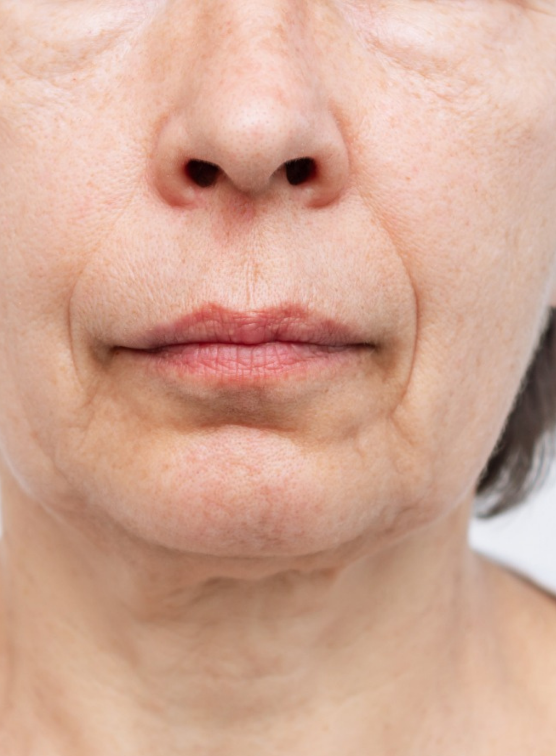before Buccal Fat Removal in Dubai at cocoona