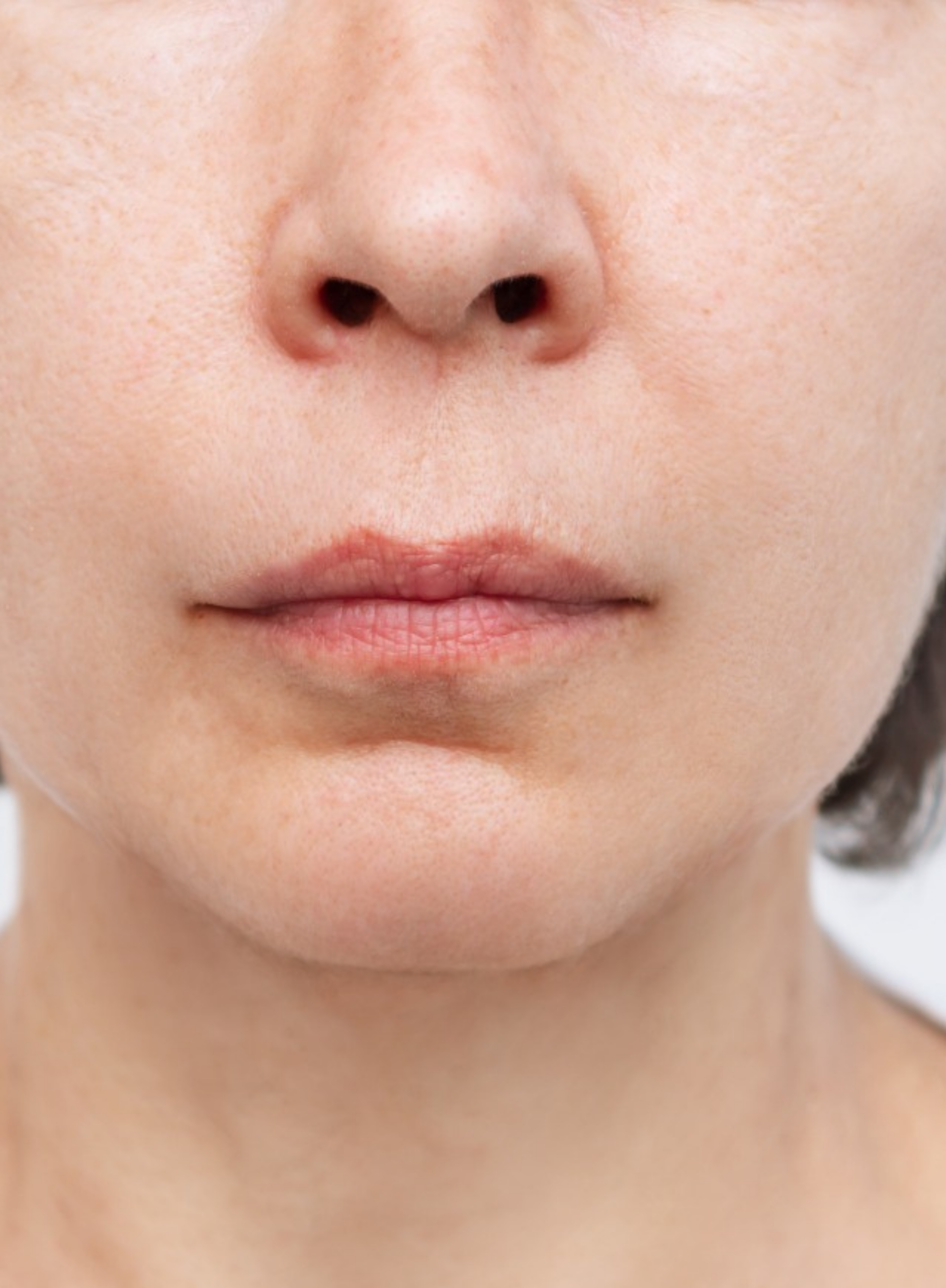 after Buccal Fat Removal in Dubai at cocoona clinic