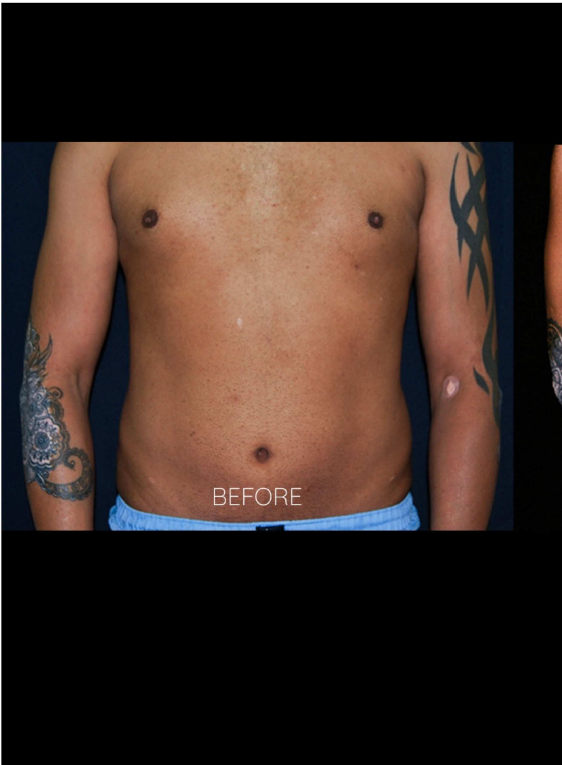 before Six-Pack Liposuction in Dubai