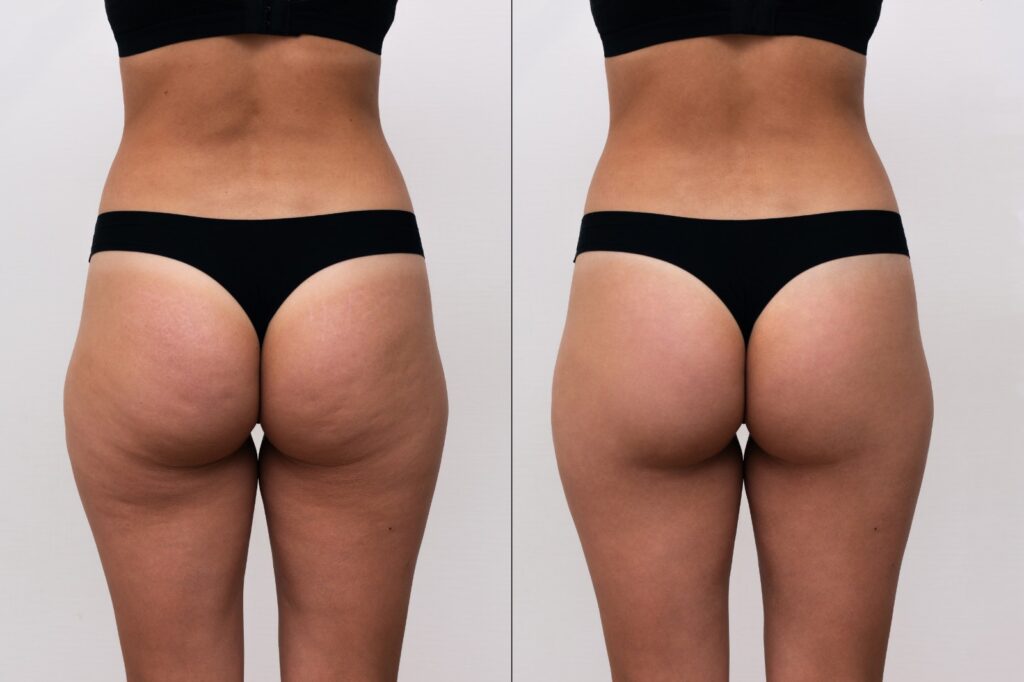 Butt-Lift-In-Dubai