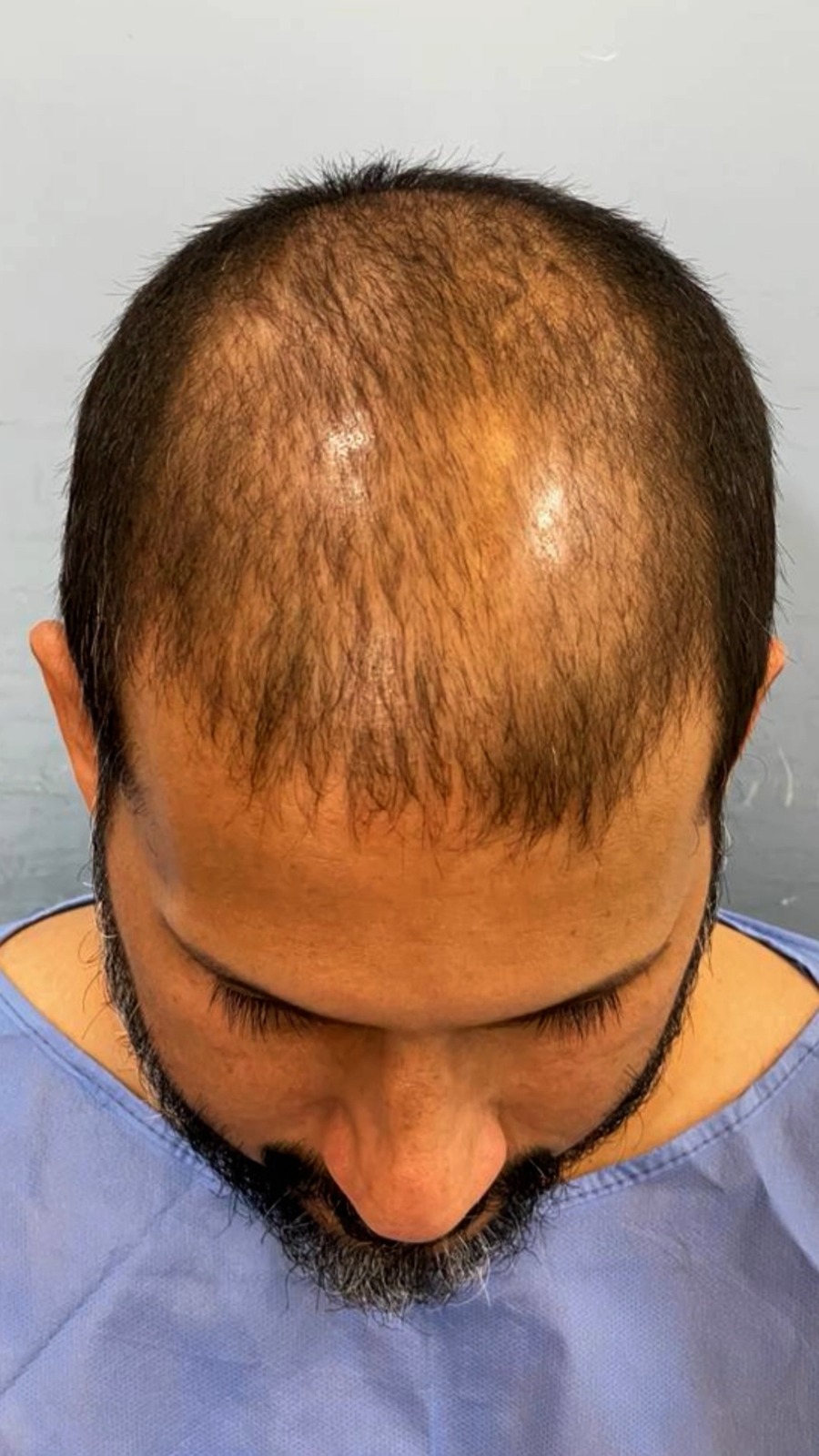 before Hair Transplant in Dubai at cocoona