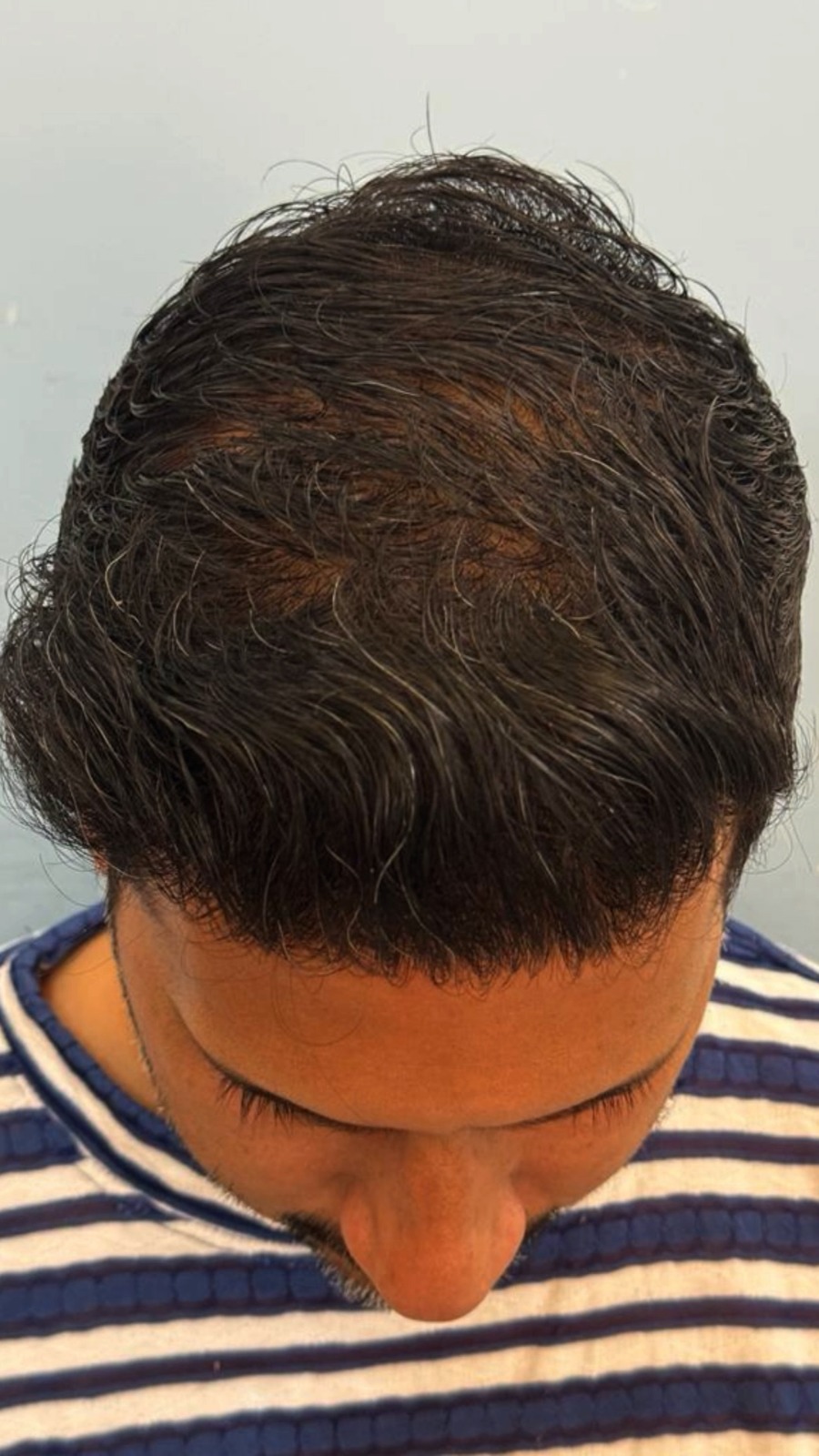 after Hair Transplant in Dubai at cocoona