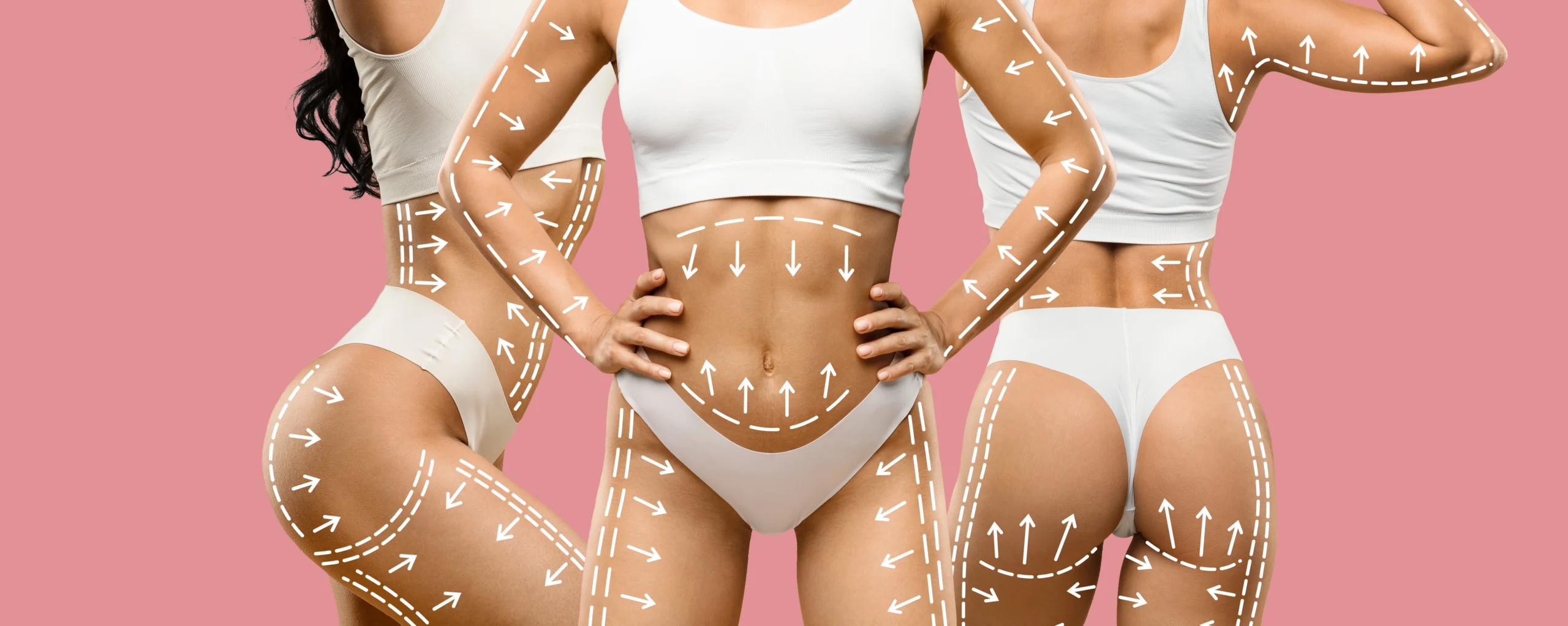 A detailed composite clinical graphic displaying a side, front, and back view of a woman's torso in white underwear against a solid pink background, with white vector arrows and dashed lines mapping out circumferential recovery zones for Full Body Liposuction In Dubai.