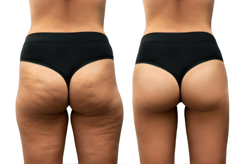 young-woman-s-thighs-buttocks-with-cellulite-before-after-sport-treatment-comparison