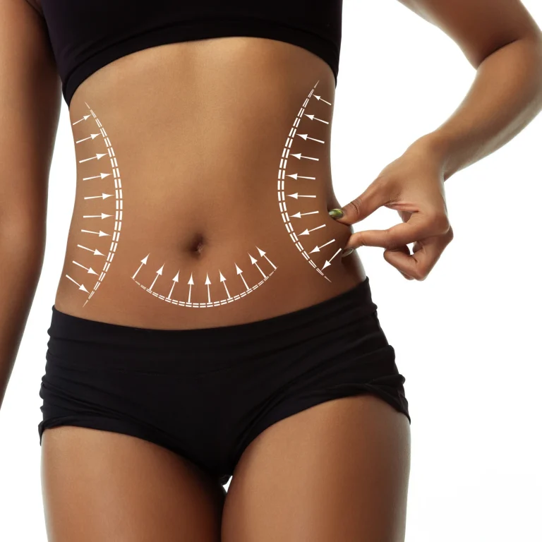 A detailed close-up frontal view of a woman's torso against a white background, wearing black compression shorts and a sports top, with white surgical diagram lines and direction arrows overlaying her waist and abdomen while a hand pinches loose flank tissue to outline a clinical treatment plan for VASER Liposuction Dubai.