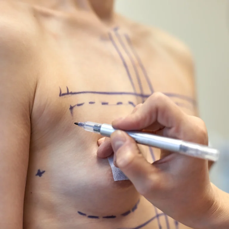Clinical topographical markings on the mammary envelope to evaluate Is Breast Augmentation in Dubai Safe.
