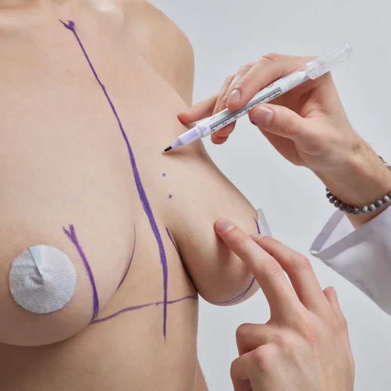 Topographical delineation of the mammary envelope to facilitate Natural-Looking Breast Augmentation in Dubai.
