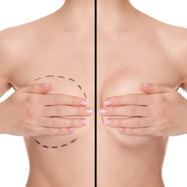 Anatomical comparison of preoperative markings vs. postoperative projection for the Best Breast Augmentation Techniques in Dubai.