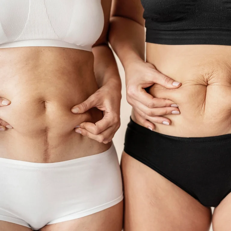 A close-up frontal view of two women standing side-by-side in underwear, both pinching the skin and tissue around their midsections to demonstrate tissue elasticity and determine candidacy for abdominal liposuction vs tummy tuck Dubai.