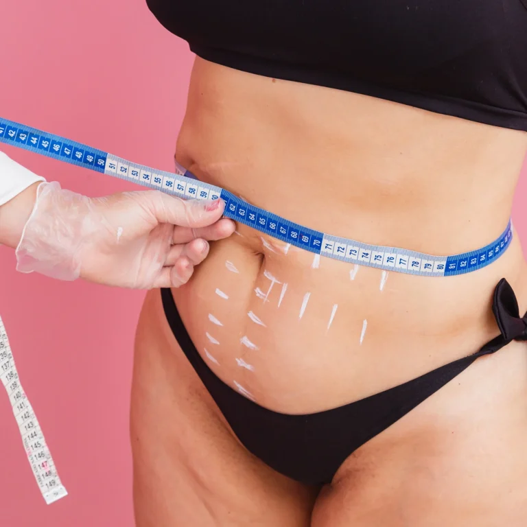A close-up side view of a woman standing in a black sports bra and bikini bottoms against a pink background, while a practitioner's gloved hands wrap a blue and white tape measure around her marked stomach to track liposuction dubai recovery.