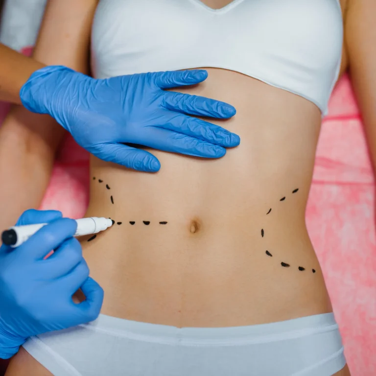An overhead, close-up view of a patient lying down in white underwear on a pink sterile sheet, while a practitioner wearing blue nitrile gloves uses a white marker to sketch symmetrical dashed lines across her waistline to highlight selection standards for the Best Liposuction Surgeon Dubai.