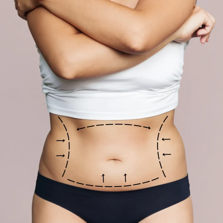 Clinical evaluation of abdominal circumference and dermal laxity for Abdominoplasty in Dubai for Mothers.