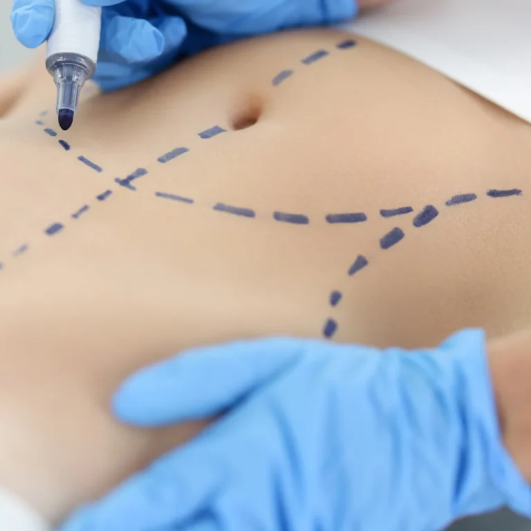 doctor-plastic-surgeon-drawing-preoperative-markings-skin-patient-abdomen-closeup