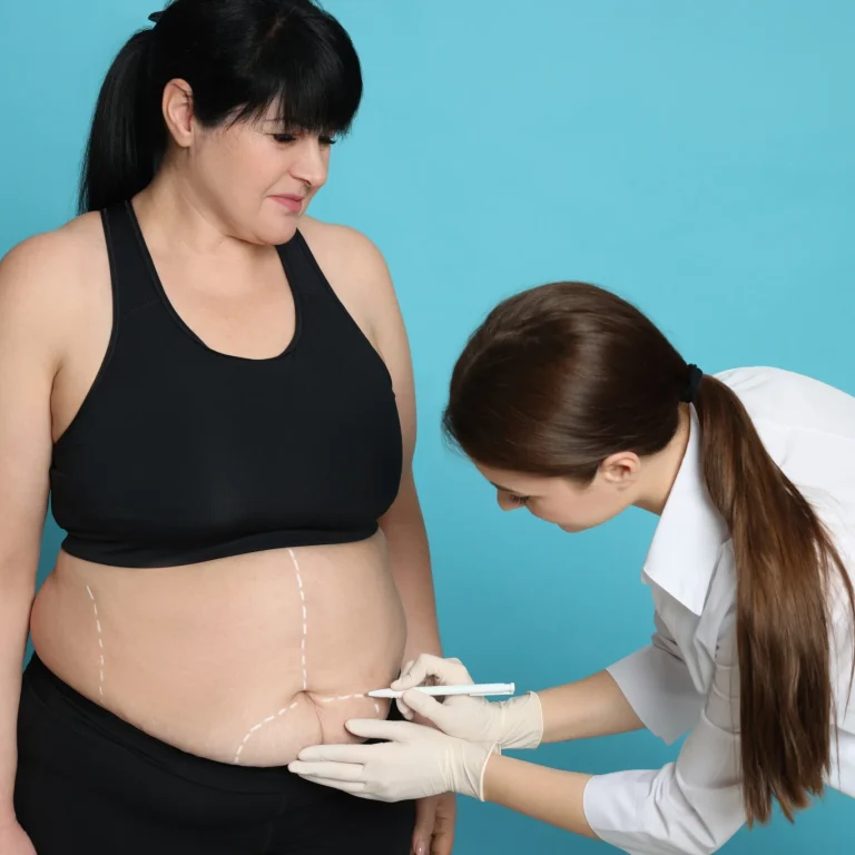 A three-quarters clinical view of a patient standing against a cyan background while a female surgeon in a white medical coat and sterile gloves uses a marker to draw precise preoperative incision lines across the lower abdomen to plan a Mommy Makeover Surgery Dubai.