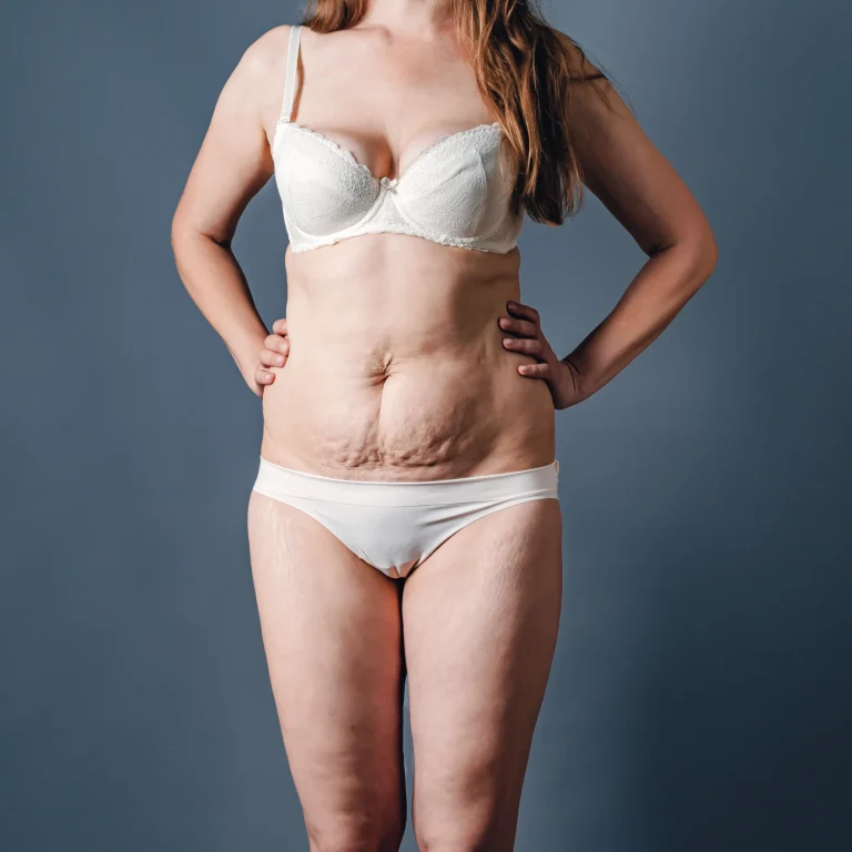 Clinical marking and surgical roadmap used when learning How to Plan Your Tummy Tuck Surgery in Dubai.