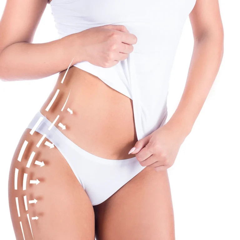 female-body-with-patterned-lines-arrows-it-isolated-white-concept-plastic-surgery-fat-removal-liposuction-cellulite