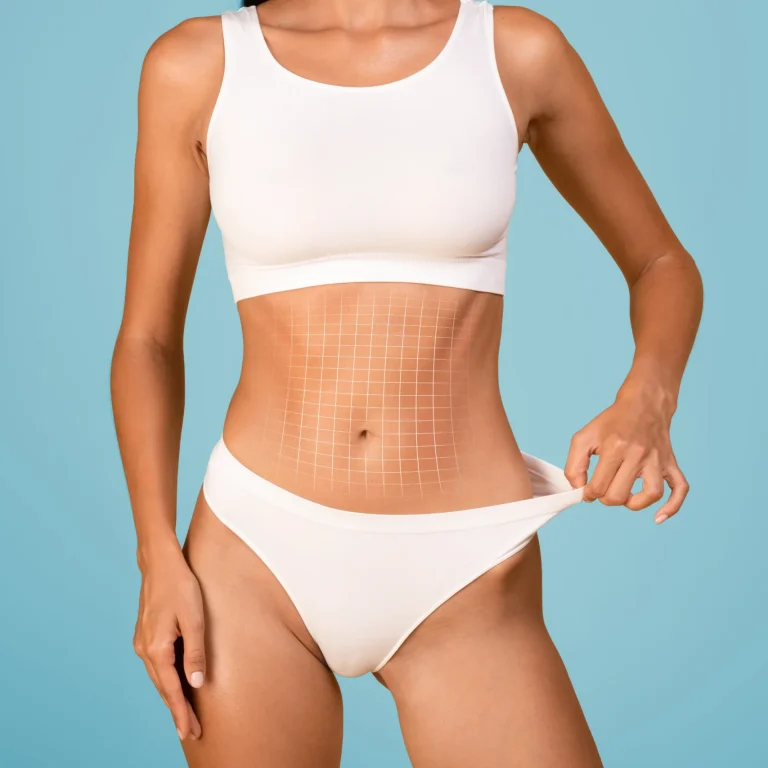 Clinical grid mapping for neo-umbilicoplasty and Umbilical Transposition in Abdominoplasty dubai.