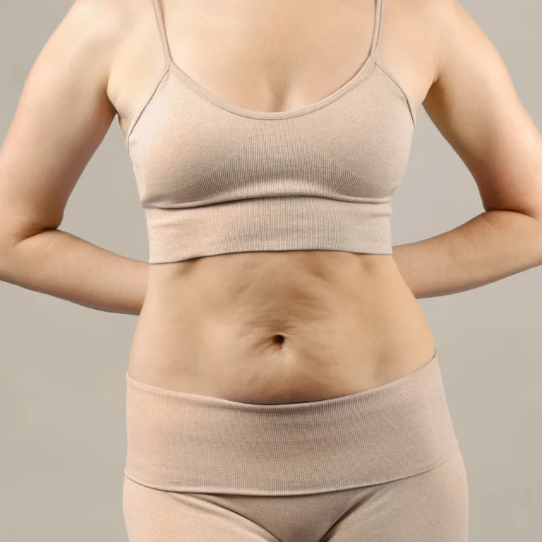 Anatomical view of infraumbilical dermal redundancy and striae distensae, a primary indication for Ask Your Surgeon Before a Tummy Tuck in Dubai.